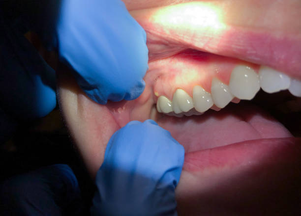 Best Emergency Wisdom Teeth Removal in Forrest City, AR